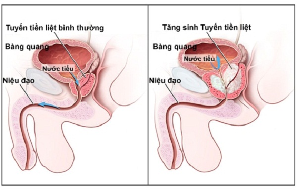 Phì đại tiền liệt tuyến có nguy hiểm không và cách điều trị bệnh