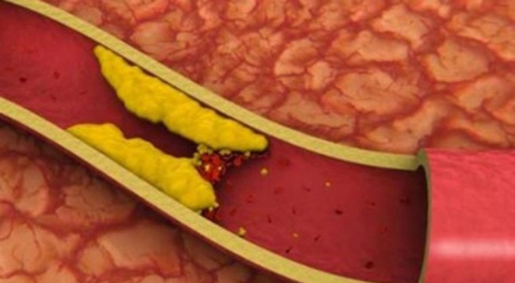 Phòng ngừa xơ vữa mạch máu như thế nào