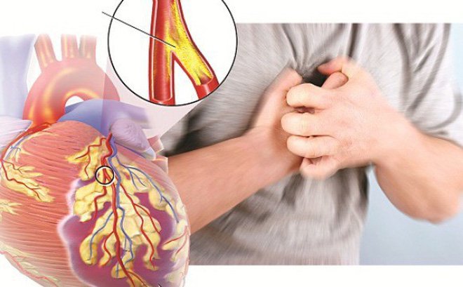 Quản lý bệnh động mạch vành