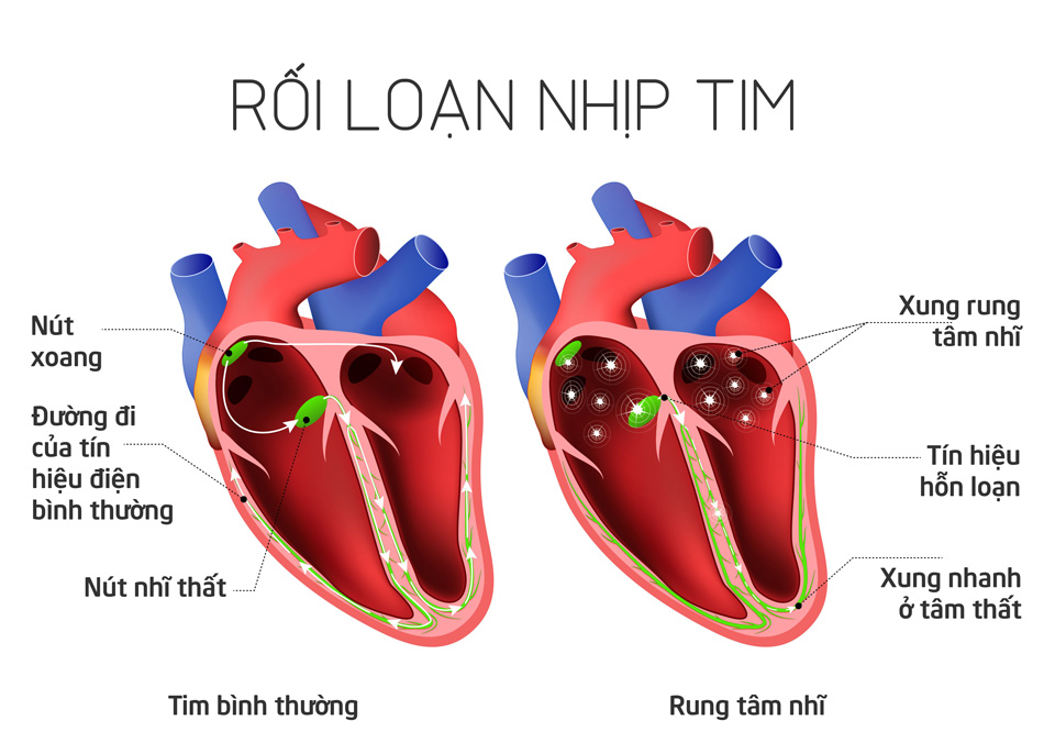 nguyên nhân rối loạn nhịp tim