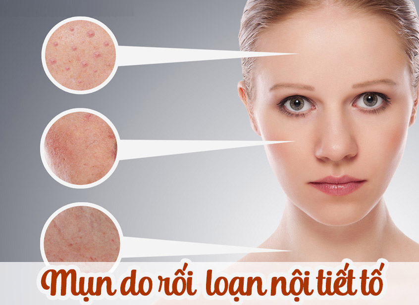 Rối loạn nội tiết tố nữ là gì và tác hại của nó