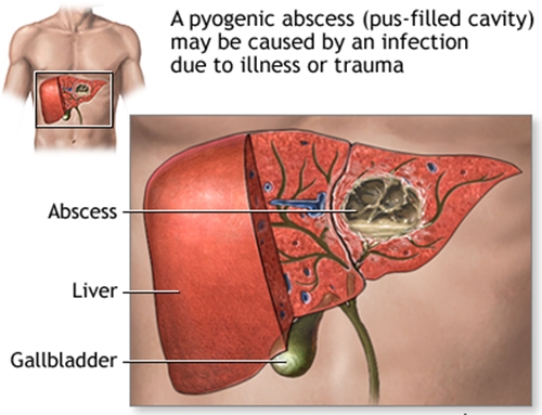 Sỏi mật có nguy hiểm không