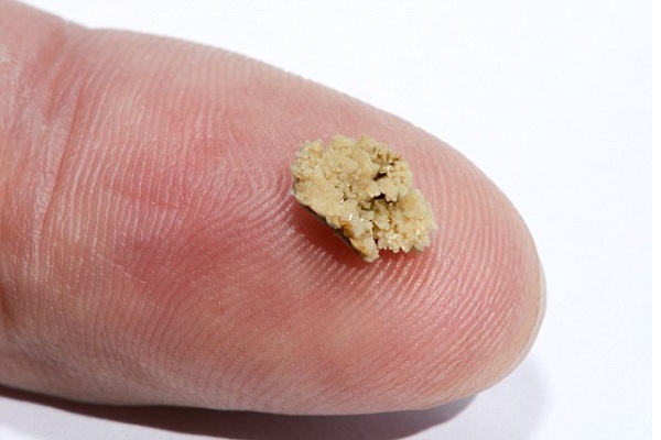 Sỏi thận 6mm có nguy hiểm không