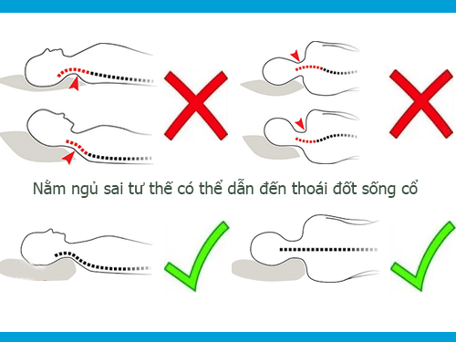 Bệnh thoái hóa đốt sống cổ là gì, nguyên nhân và cách điều trị