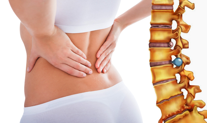 Thoát vị đĩa đệm và cách điều trị an toàn hiệu quả