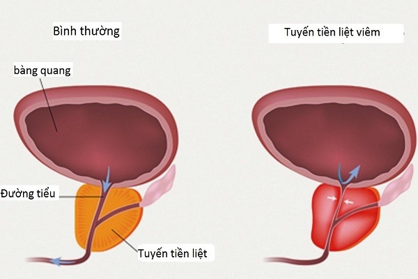 Thời gian điều trị viêm tuyến tiền liệt là bao lâu