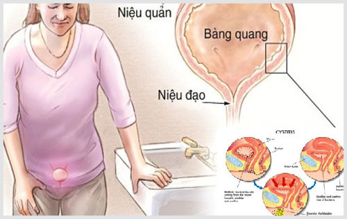 Thuốc điều trị viêm đường tiết niệu an toàn hiệu quả