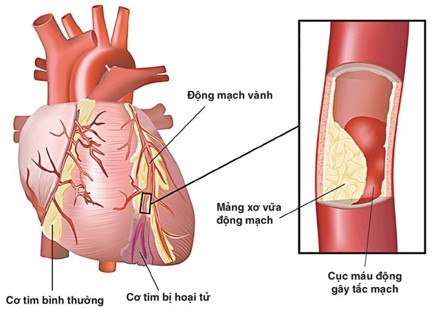 Thuốc phòng ngừa nhồi máu cơ tim loại nào tốt