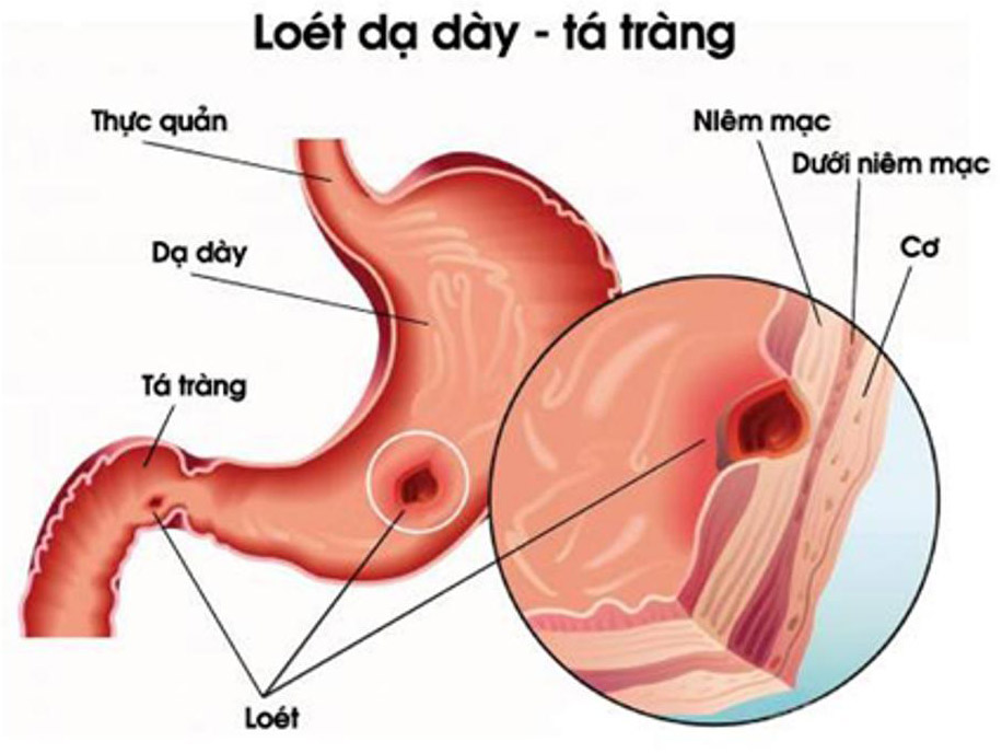 Triệu chứng của viêm loét dạ dày tá tràng là gì và cách chữa bệnh ra sao