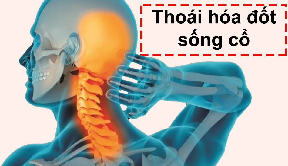 Triệu chứng thoái hóa đốt sống cổ và cách phòng ngừa hiệu quả