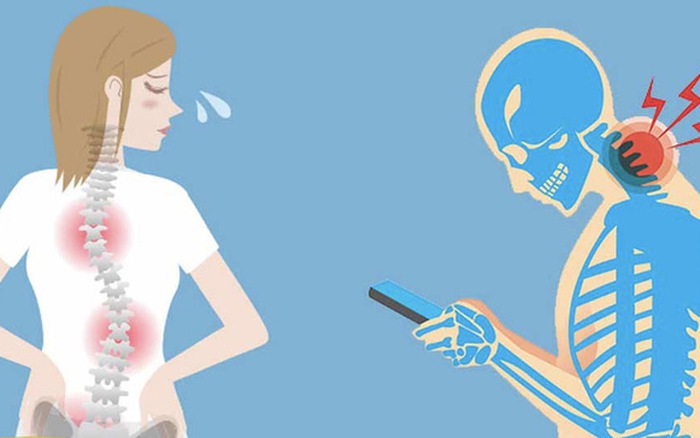 Triệu chứng thoái hóa đốt sống cổ và cách phòng ngừa hiệu quả