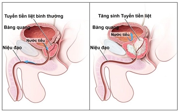 Triệu chứng u xơ tiền liệt tuyến là gì và cách điều trị ra sao
