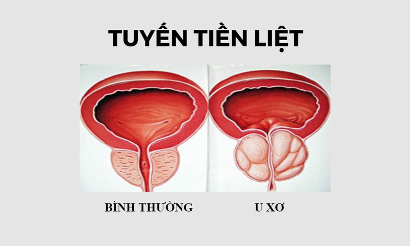 Triệu chứng u xơ tiền liệt tuyến là gì và cách điều trị ra sao