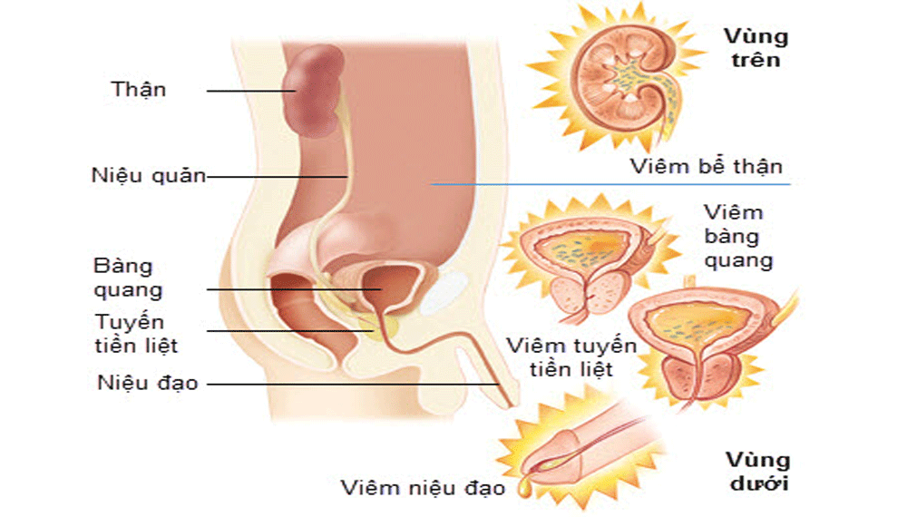 triệu chứng u xơ tuyến tiền liệt
