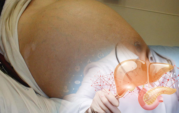 Triệu chứng xơ gan giai đoạn cuối