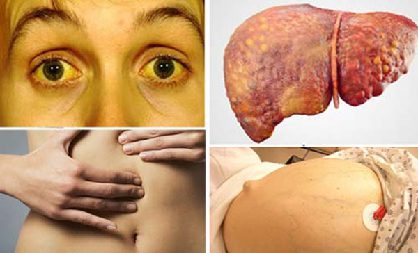 Triệu chứng xơ gan giai đoạn cuối