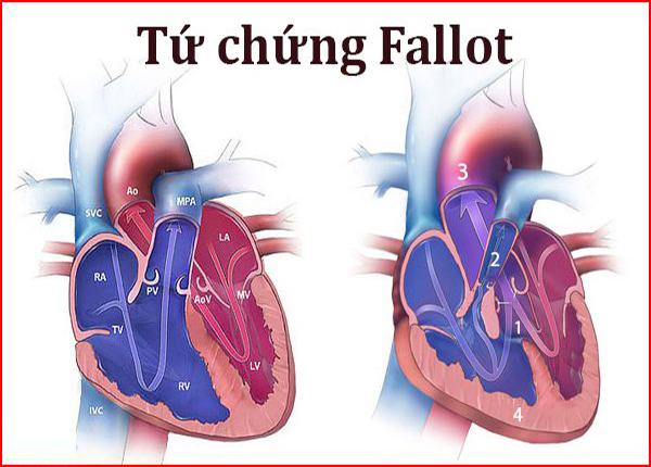 Tứ chứng Fallot