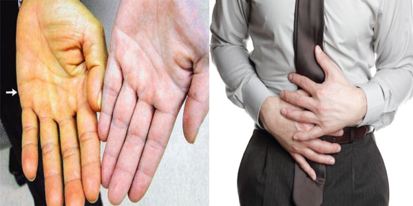 u gan ác tính có chữa được không