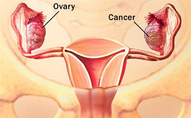 Ung thư buồng trứng có chết không