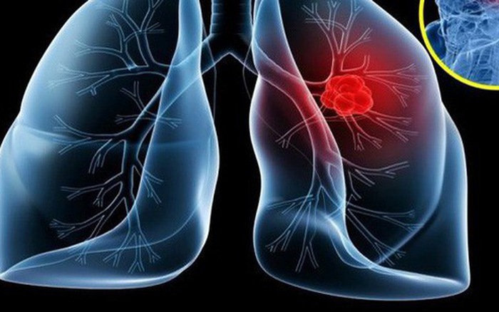 ung thư phổi có bao nhiêu giai đoạn và cách phòng tránh bệnh