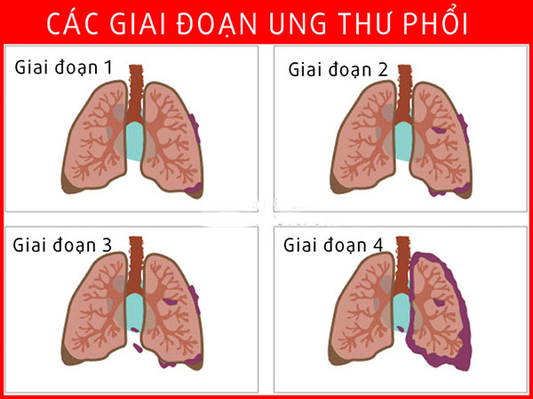 ung thư phổi có bao nhiêu giai đoạn và cách phòng tránh bệnh