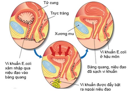 Vậy nhiễm khuẩn đường tiết niệu là gì và các phòng bệnh ra sao