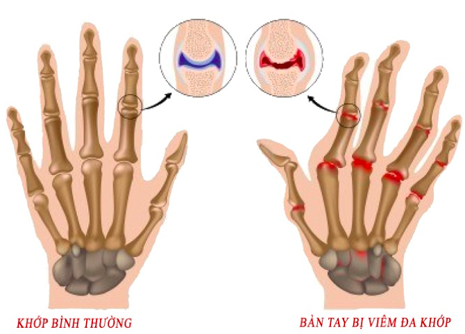 Bệnh viêm đa khớp và cách chữa trị