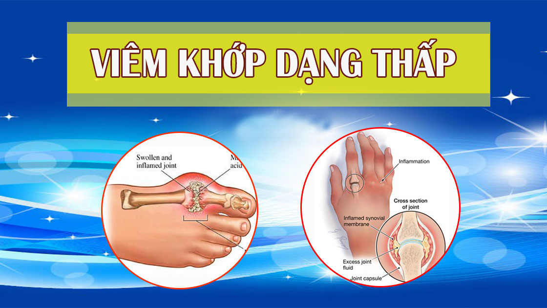 Bệnh viêm khớp dạng thấp có chữa khỏi được không và chữa như thế nào