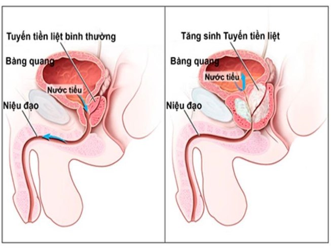 Viêm tiền liệt tuyến có nguy hiểm không