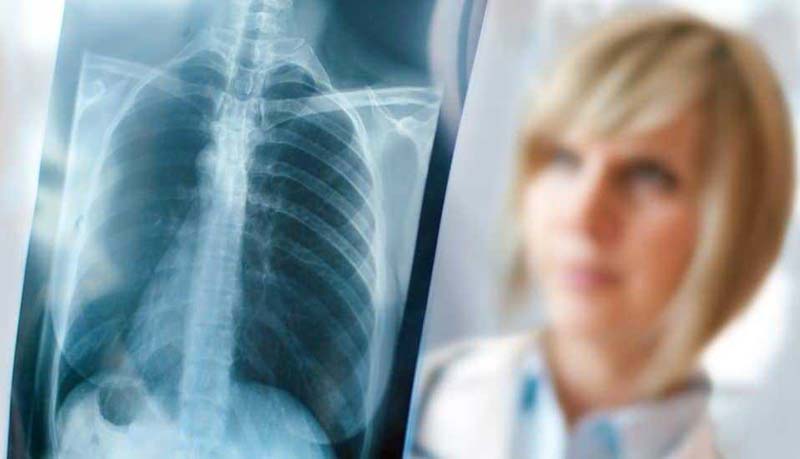 Xơ phổi có nguy hiểm không và cách điều trị ra sao