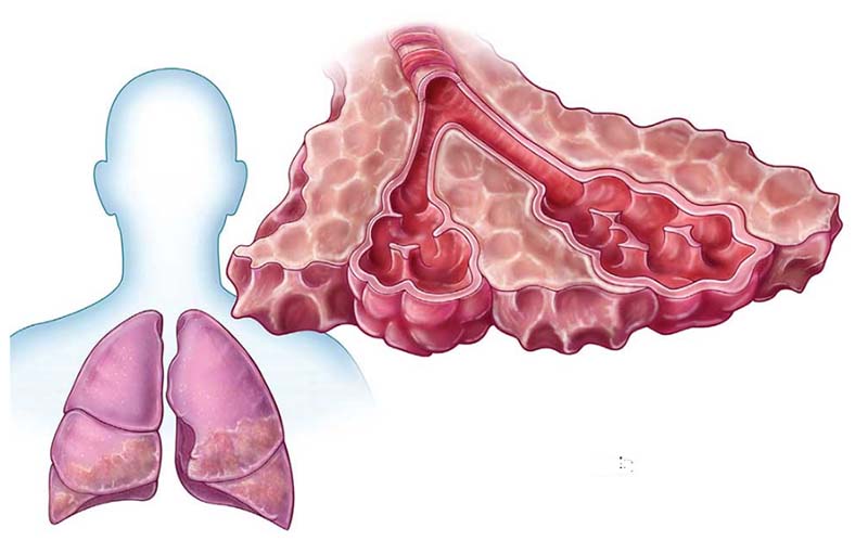 Xơ phổi là gì cách phòng và điều trị bệnh ra sao
