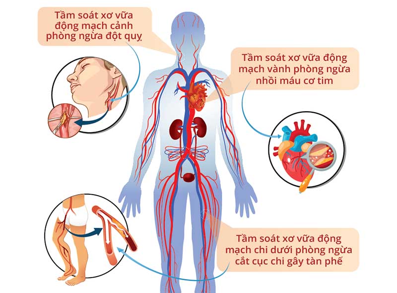 Xơ vữa động mạch có chữa được không