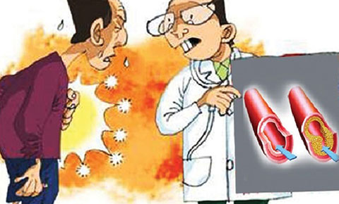 Xơ vữa động mạch ở người già