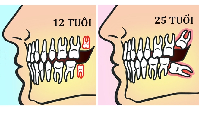 Những điều bạn nhất định phải biết trước khi nhổ răng khôn