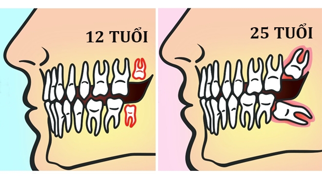 Tại Nha khoa Phạm Dương, răng khôn của bạn sẽ được nhổ thế nào?
