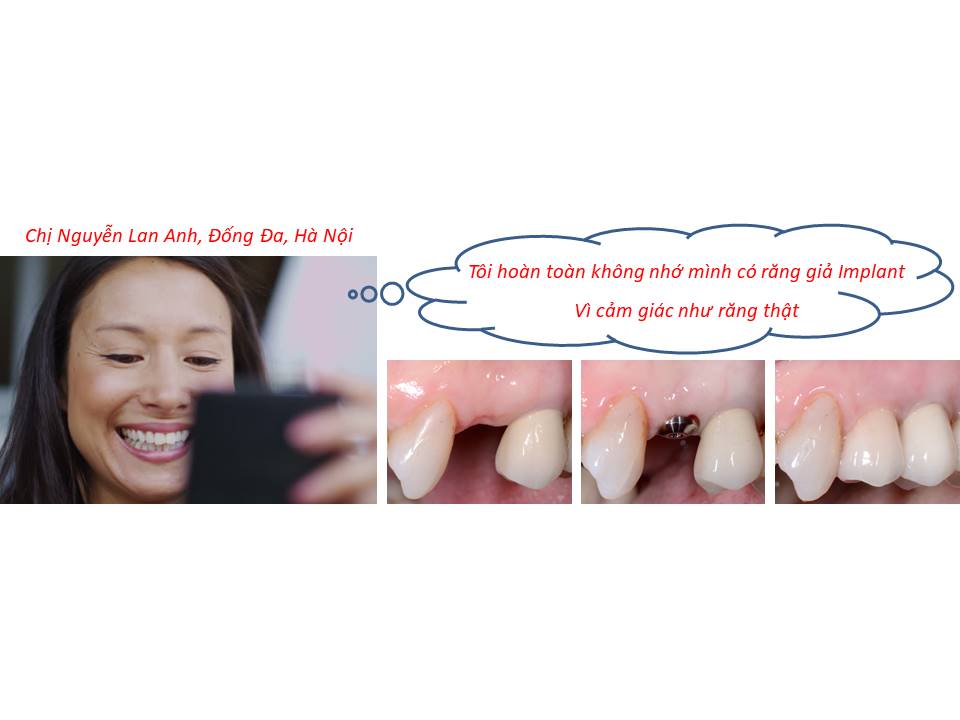 Giải pháp mất răng với cấy ghép răng Implant