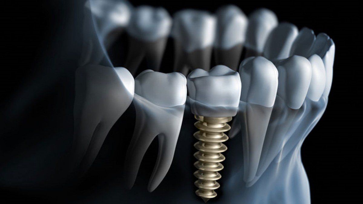 Quy trình cấy ghép Implant tại PhamDuong Dental Studio