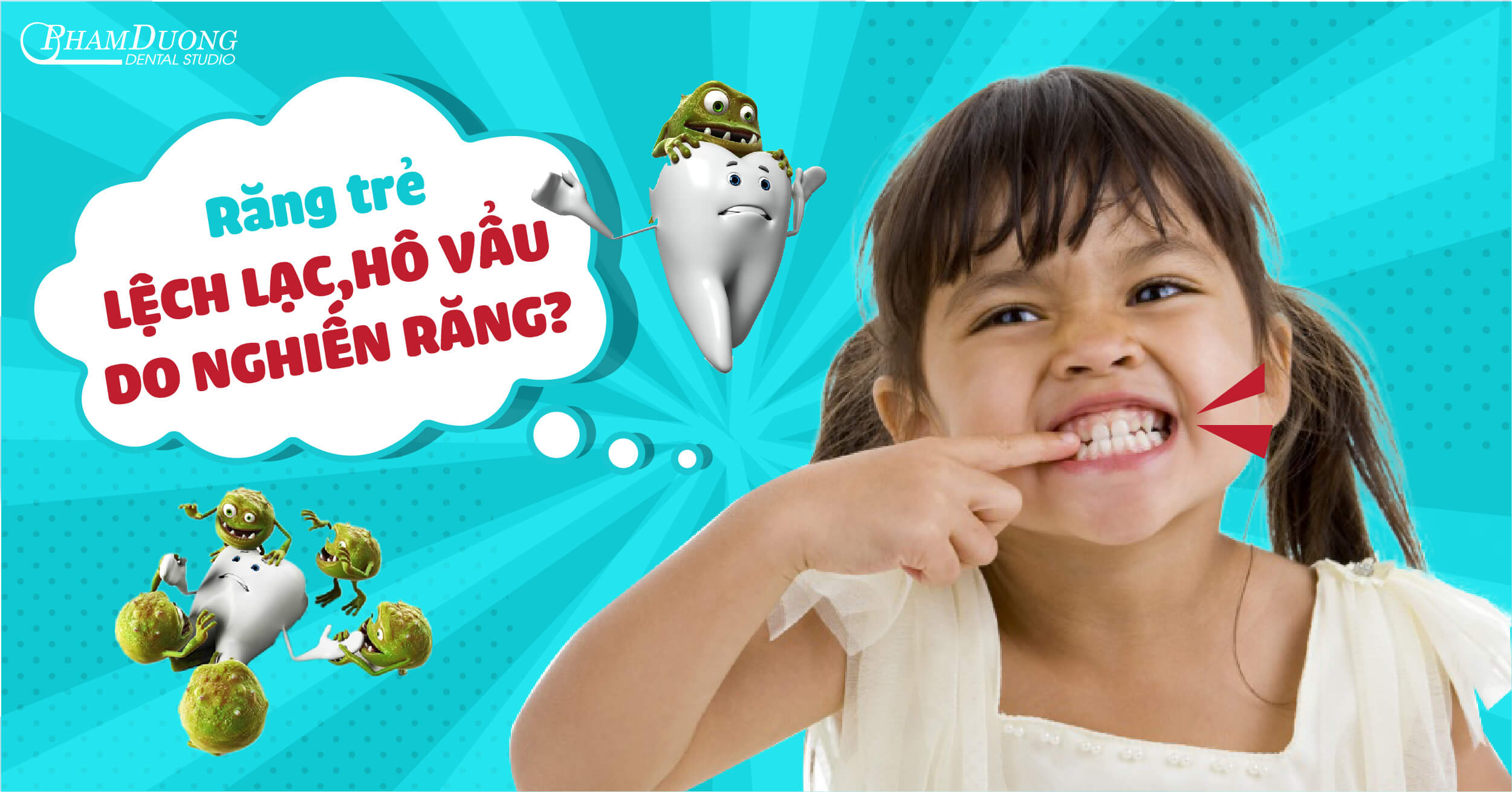 Nghiến răng ở trẻ, nguy cơ gây lệch lạc, hô răng