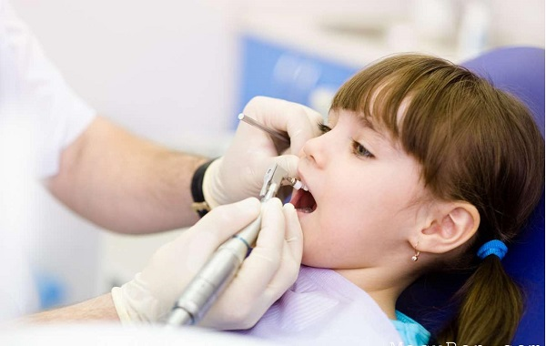 Hàn phòng ngừa sâu răng cho trẻ em