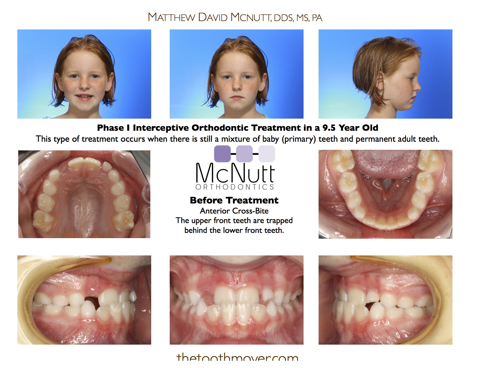 Độ tuổi niềng răng phù hợp nhất là khi nào