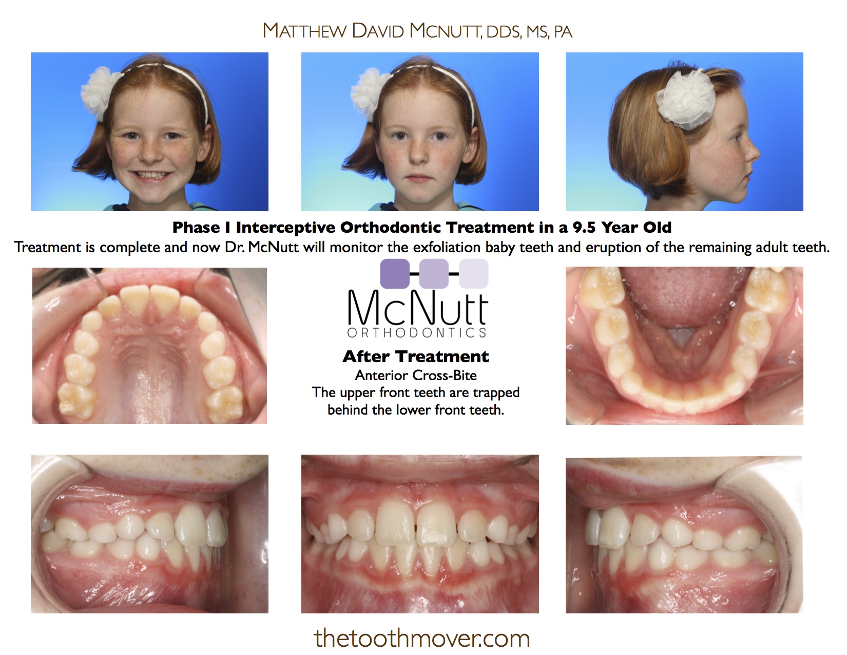 Từ 11-17 là độ tuổi niềng răng phù hợp nhất