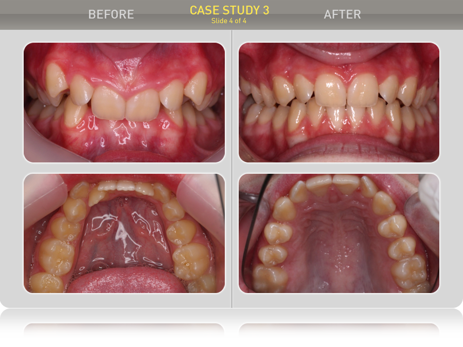 Ảnh TRƯỚC và SAU khi điều trị với MyOBrace