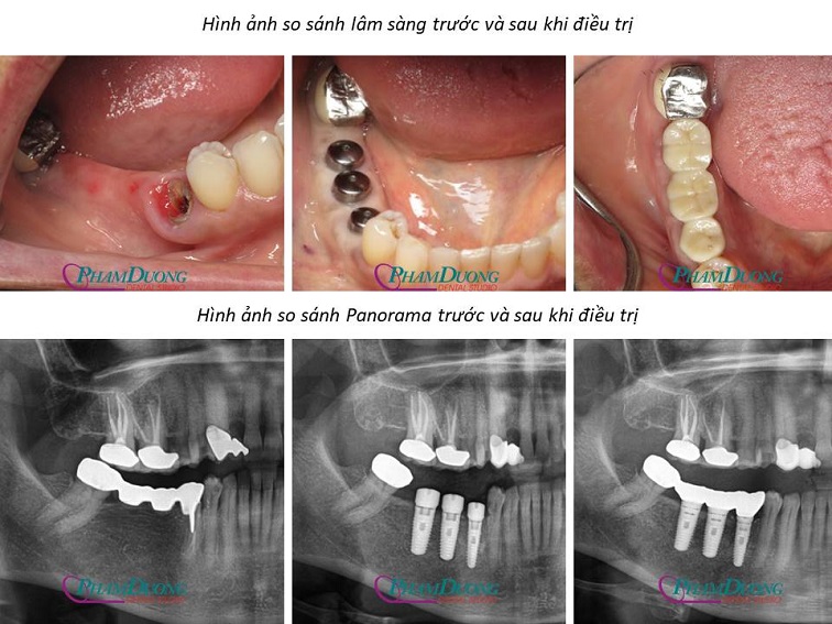 So sánh Panorama trước và sau khi điều trị