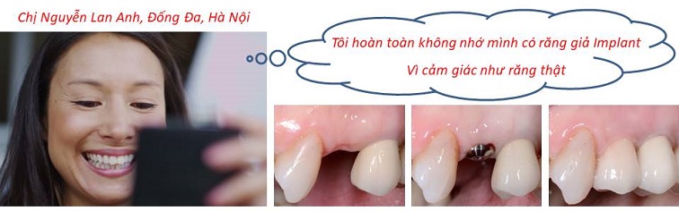 cấy ghép Implant - 1 giải pháp hoàn hảo