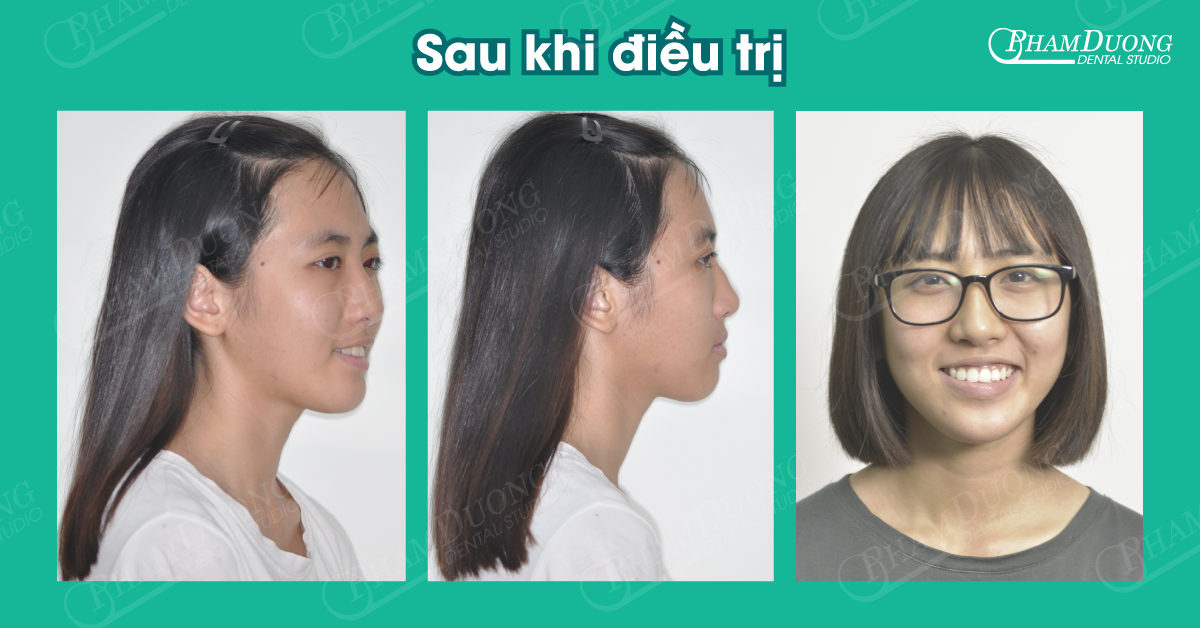 Nguyễn Ngọc Anh - Sau khi điều trị răng móm