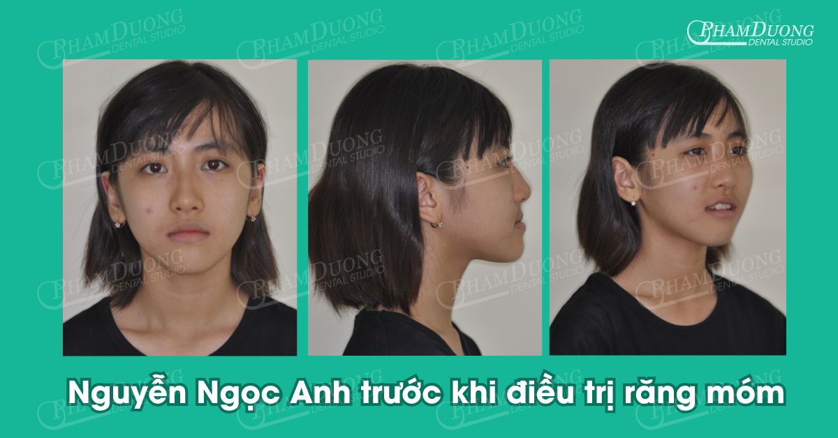 Nguyễn Ngọc Anh - Trước khi điều trị răng móm
