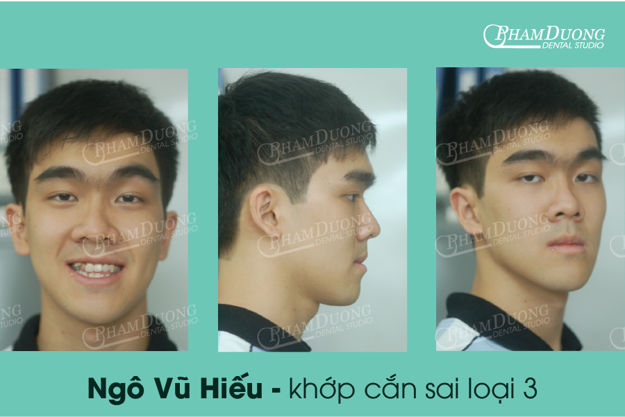 Hình ảnh: bệnh nhân vị răng móm - khớp cắn sai loại 3 - trước điều trị
