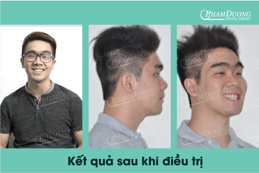 Kết quả sau điều trị răng móm của bạn Ngô Vũ Hiếu