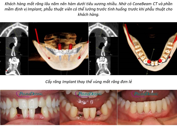 Cấy Implant cho vùng răng cửa mất đơn lẻ