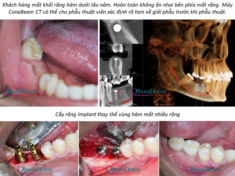 Cấy Implant cho vùng răng hàm mất nhiều răng